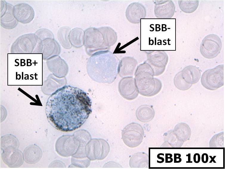 Bone marrow aspirate touch prep, SBB, 100x, showing larger SBB+ blast and smaller SBB- blast